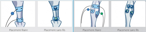 placement electrodes-tendinopathie tendon achille